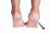 Why Dry Skin Can Lead to Cracked Heels