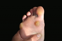 What is a Plantar Wart?