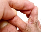 Differentiating Between Eczema and Athlete's Foot