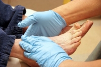 Why Diabetics Have to Care for Their Feet