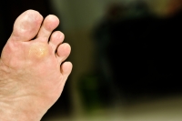 What Do Plantar Warts Look Like?