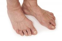 Telltale Signs of Rheumatoid Arthritis in the Feet